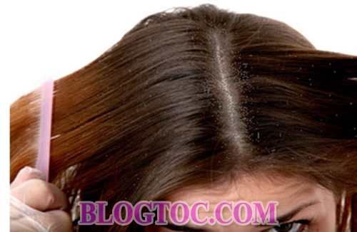 Cách trị gàu hiệu quả nhất dứt điểm vảy gàu cho mái tóc chắc khỏe bằng các liệu pháp thiên nhiên 1
